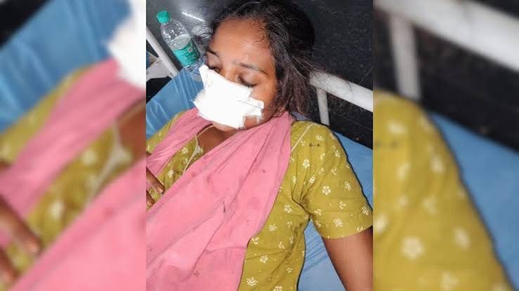 Man Bites Off Wife's Nose After She Refuses To Return Home